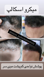 انجام اسکالپ سر اصفهان