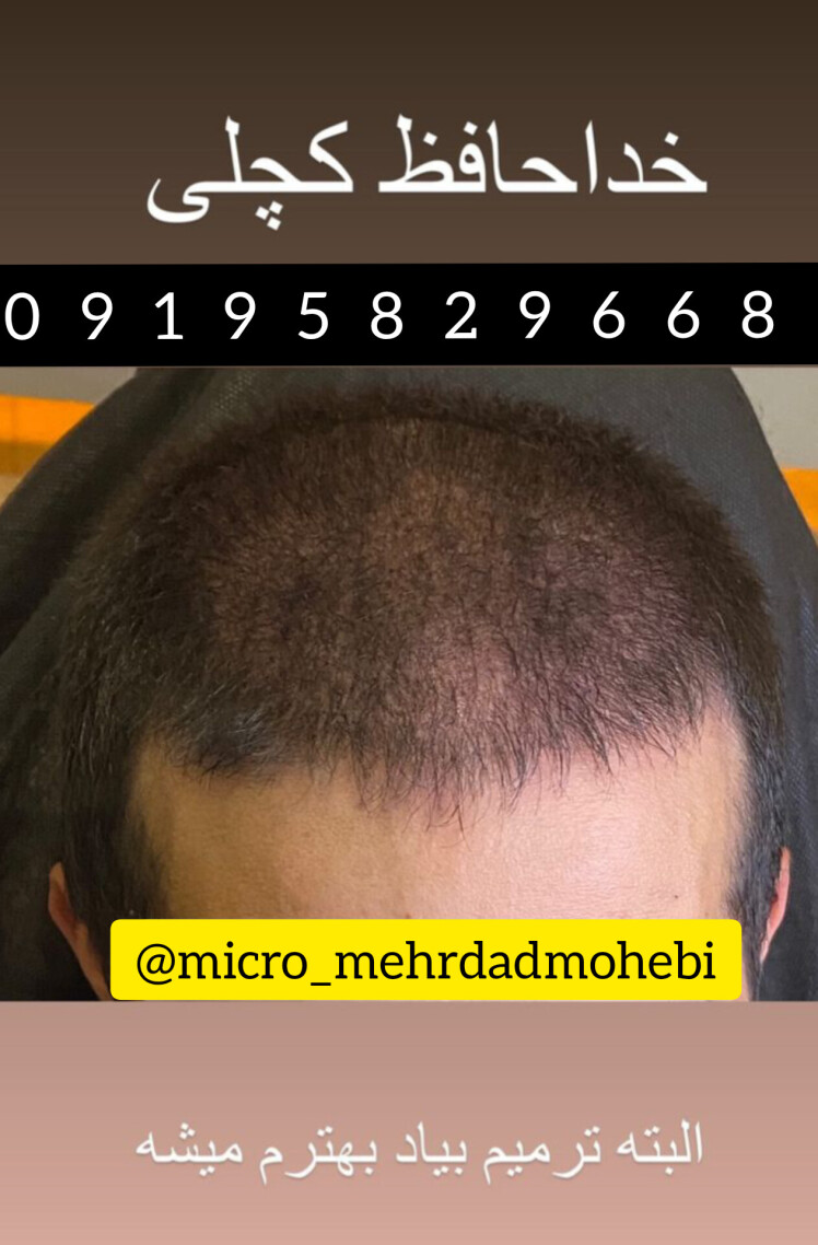 میکرو اسکالپ سر آقایان اصفهان